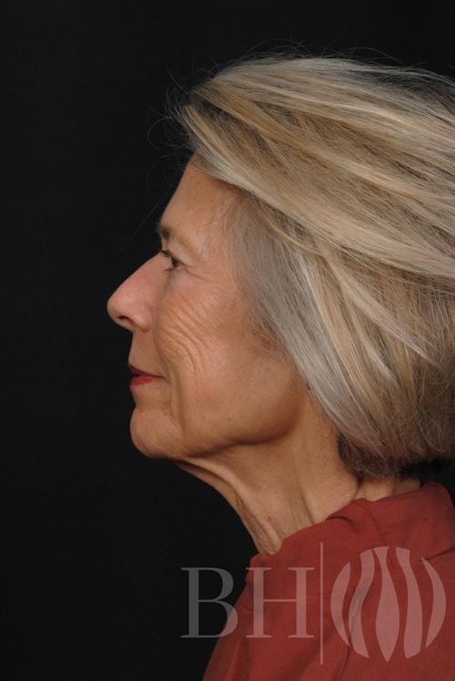 Facelift Before & After