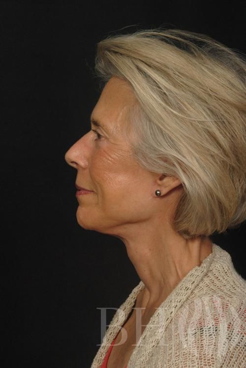 Facelift Before & After