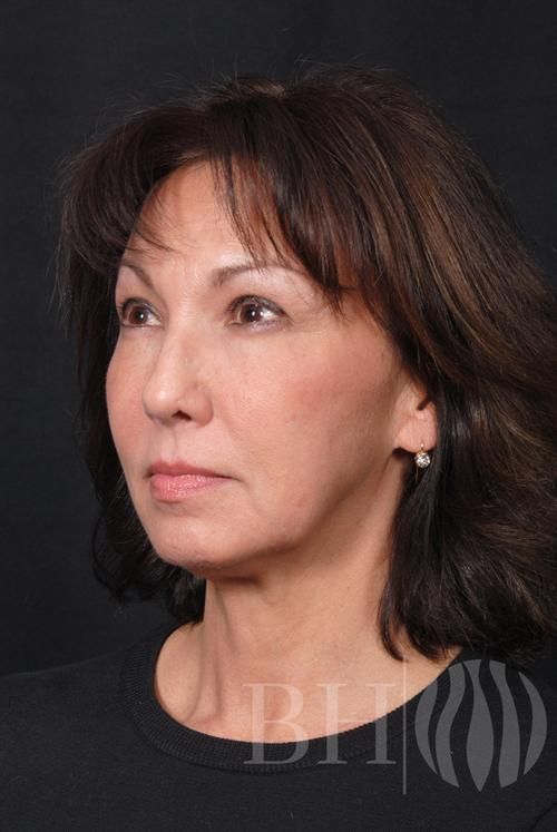 Facelift Before & After