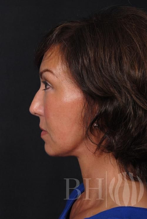 Facelift Before & After