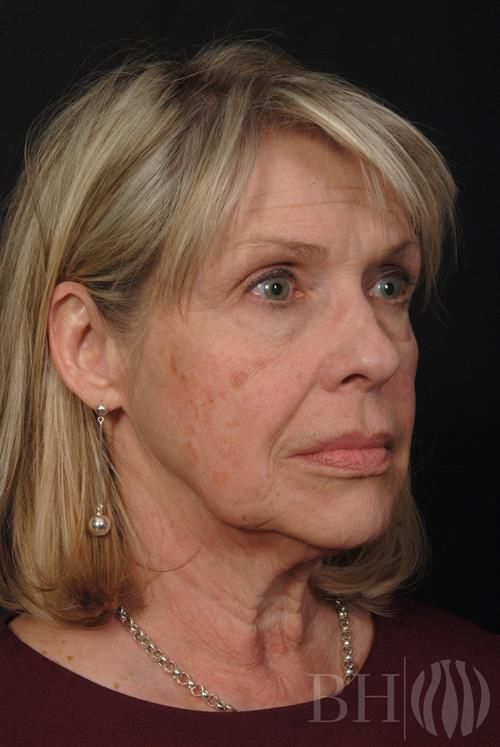 Facelift Before & After