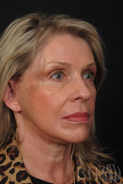 Facelift Before & After