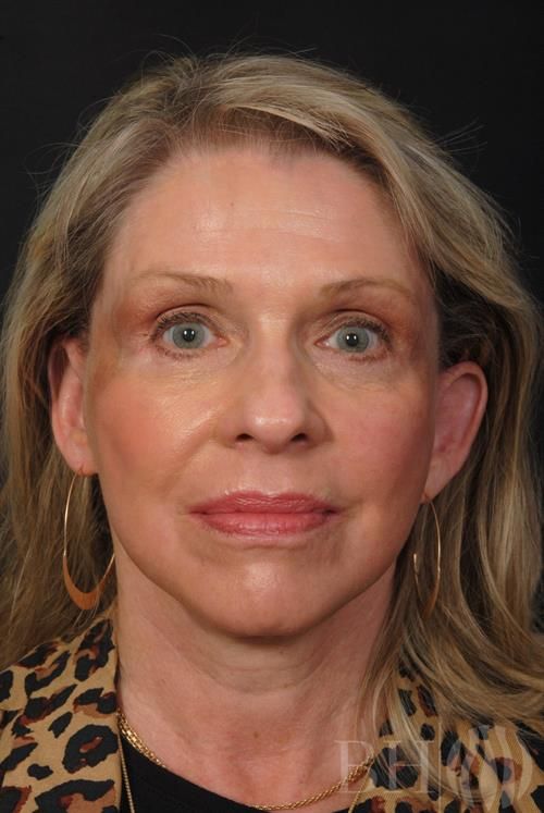 Facelift Before & After