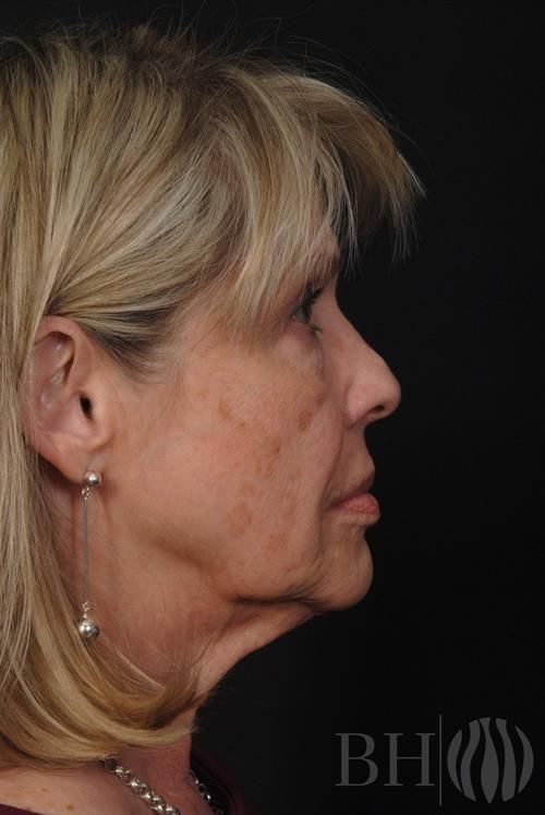 Facelift Before & After