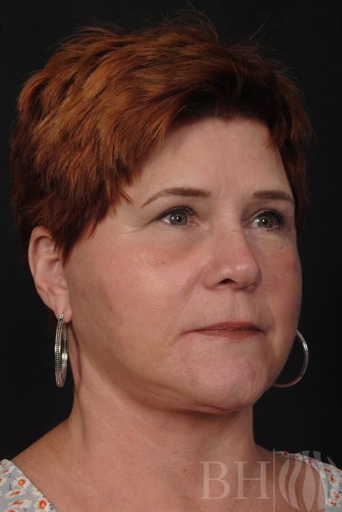 Facelift Before & After