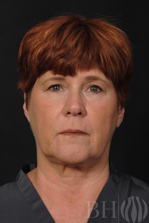 Facelift Before & After