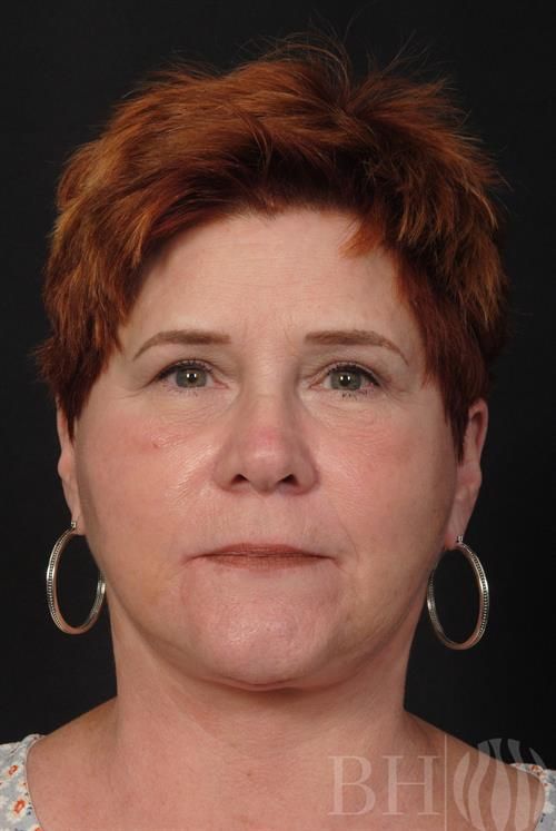 Facelift Before & After