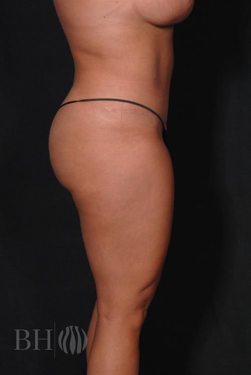 Tummy Tuck Before & After