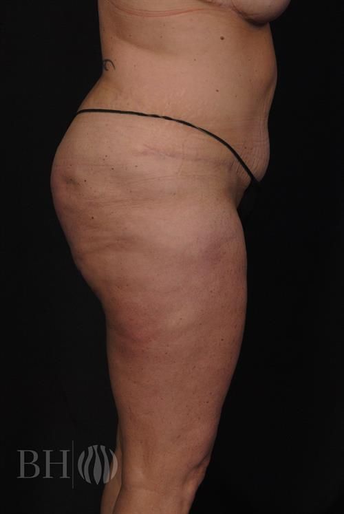 Tummy Tuck Before & After