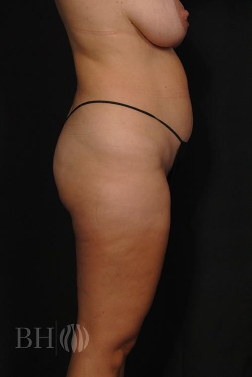 Tummy Tuck Before & After