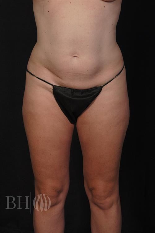 Tummy Tuck Before & After