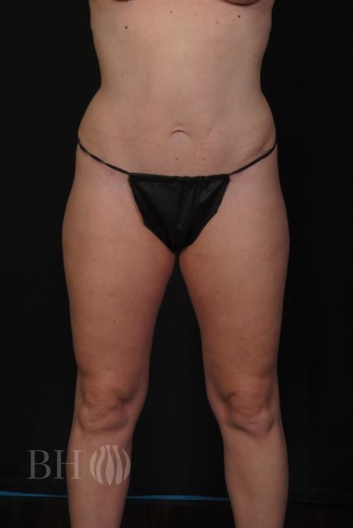 Tummy Tuck Before & After