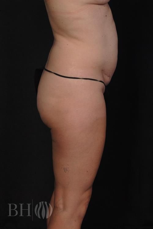 Tummy Tuck Before & After