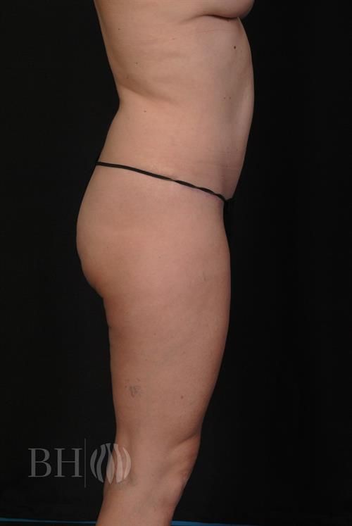 Tummy Tuck Before & After