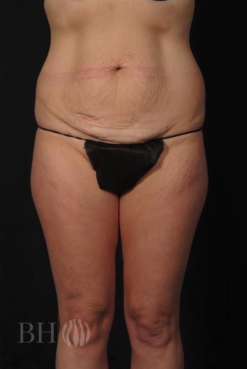 Tummy Tuck Before & After