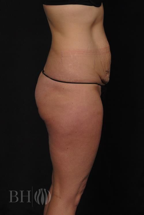 Tummy Tuck Before & After