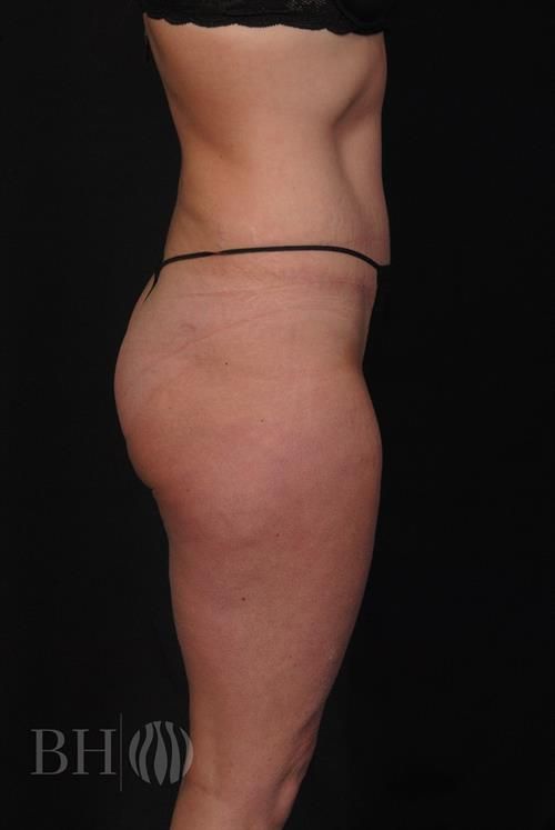 Tummy Tuck Before & After