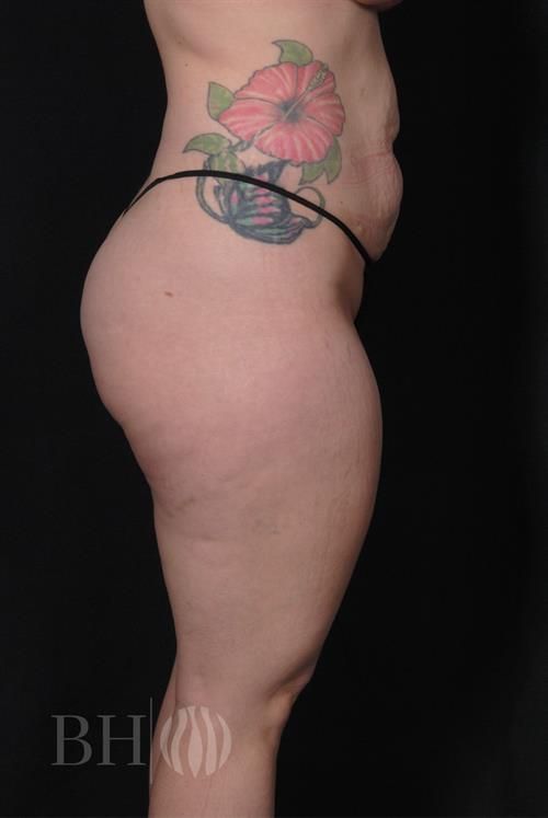 Tummy Tuck Before & After