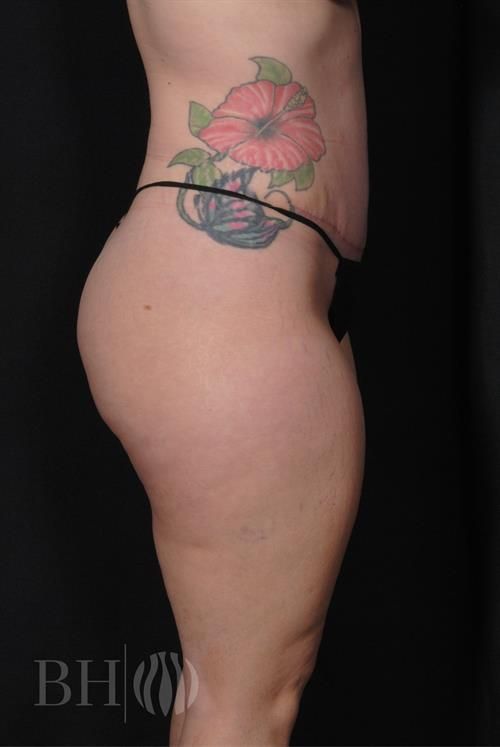 Tummy Tuck Before & After