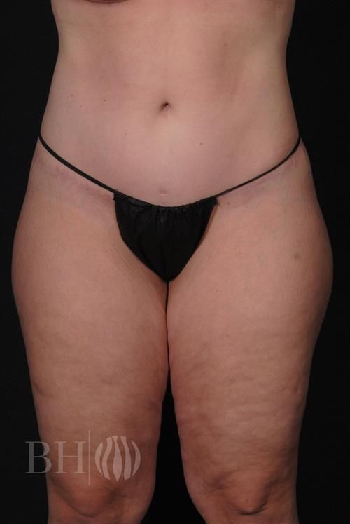 Tummy Tuck Before & After