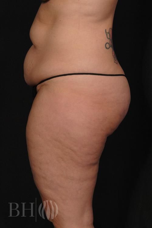 Tummy Tuck Before & After