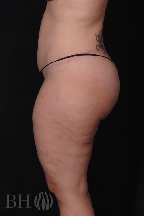 Tummy Tuck Before & After