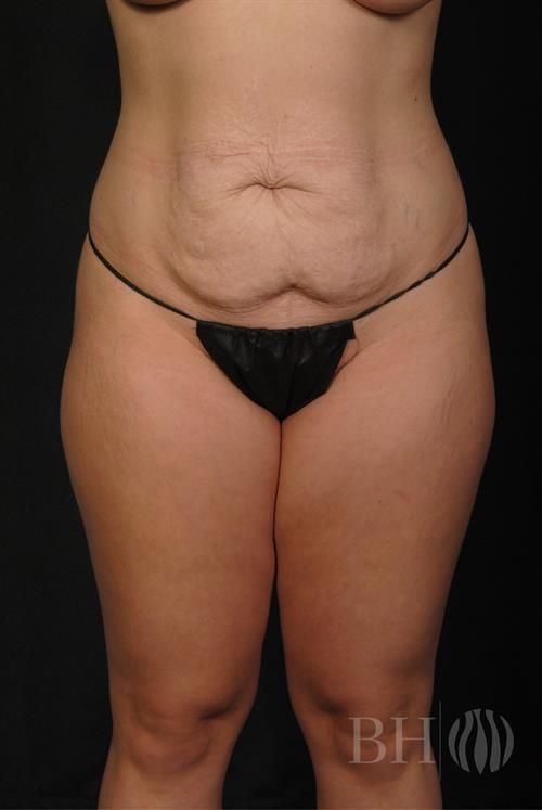 Tummy Tuck Before & After