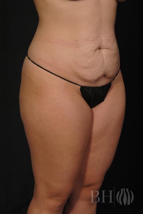 Tummy Tuck Before & After