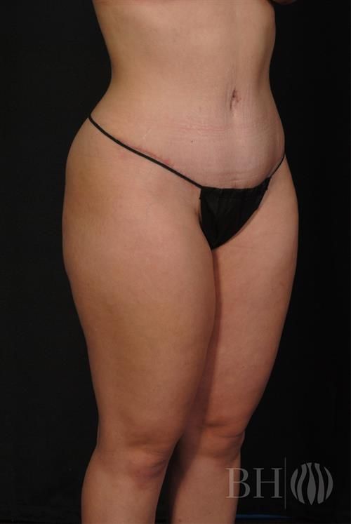 Tummy Tuck Before & After