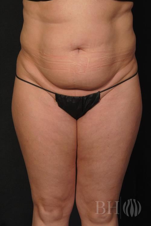 Tummy Tuck Before & After