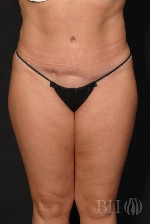 Tummy Tuck Before & After