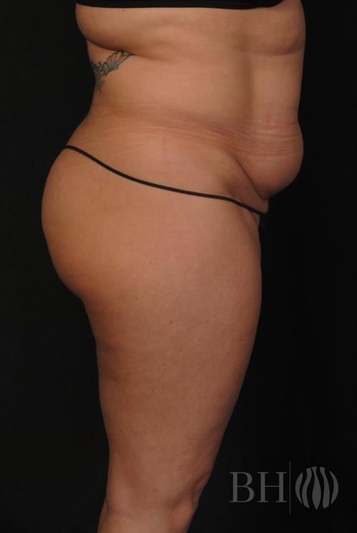 Tummy Tuck Before & After