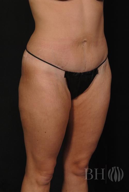 Tummy Tuck Before & After
