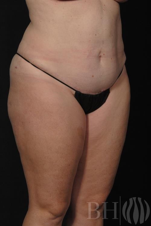 Tummy Tuck Before & After