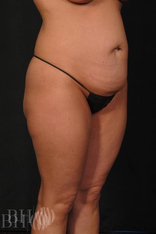 Tummy Tuck Before & After