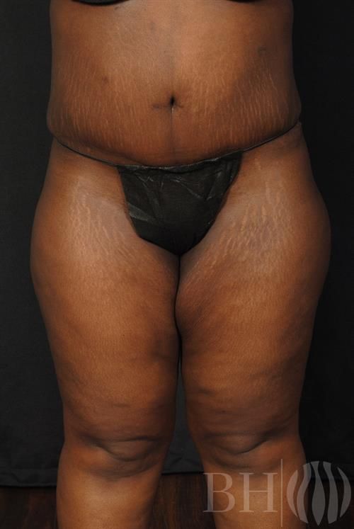 Tummy Tuck Before & After