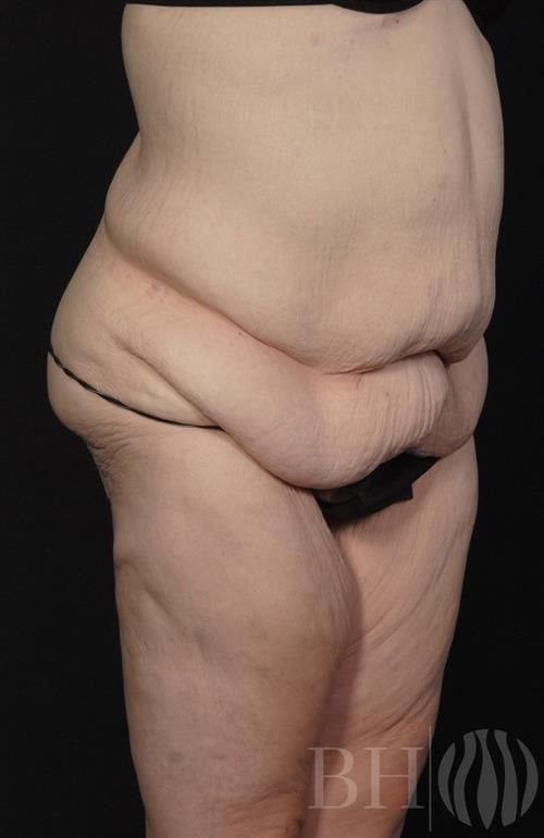 Tummy Tuck Before & After