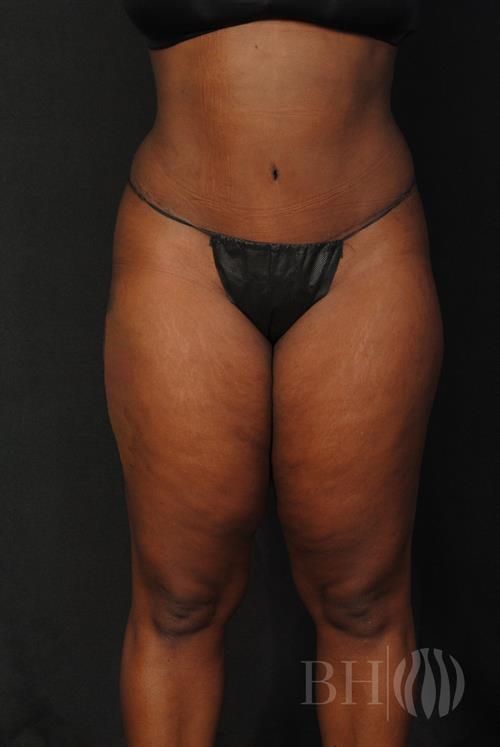 Tummy Tuck Before & After