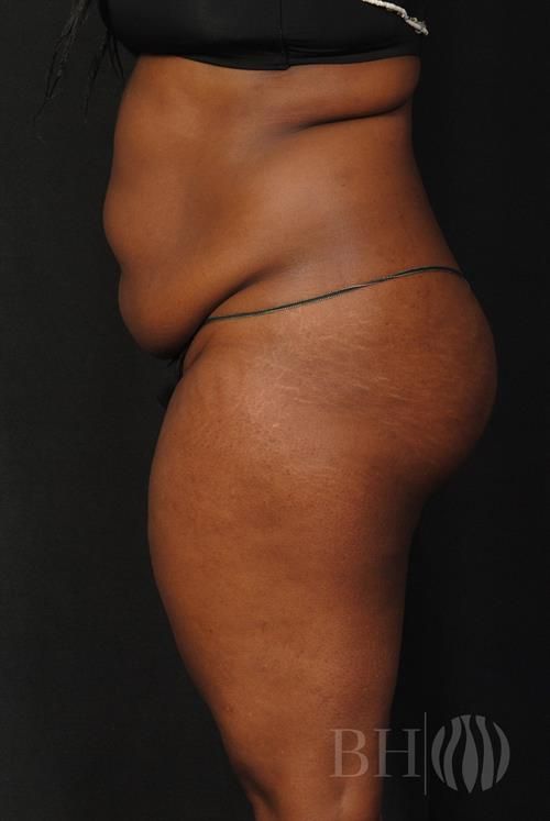 Tummy Tuck Before & After