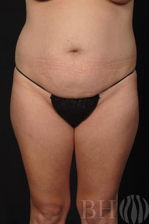 Tummy Tuck Before & After
