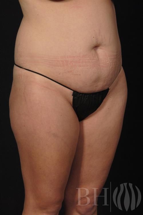 Tummy Tuck Before & After