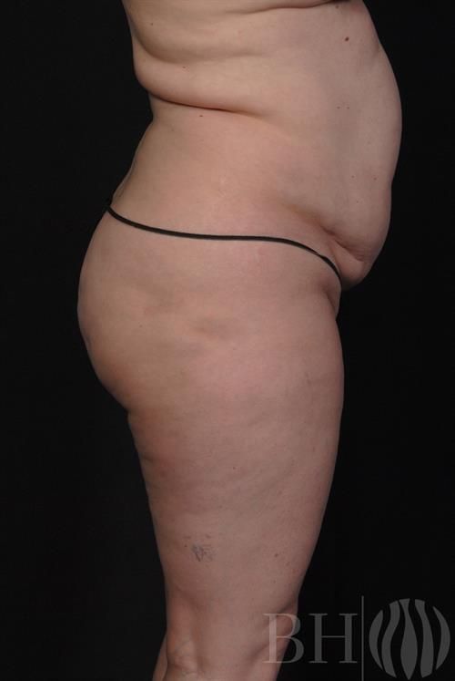 Tummy Tuck Before & After