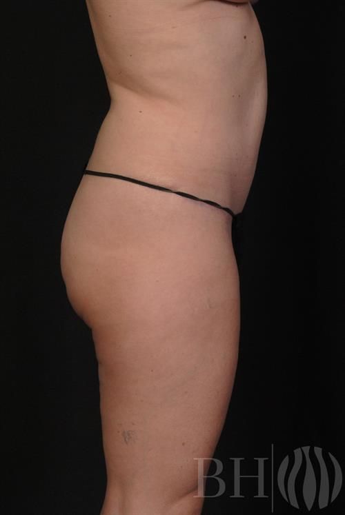 Tummy Tuck Before & After