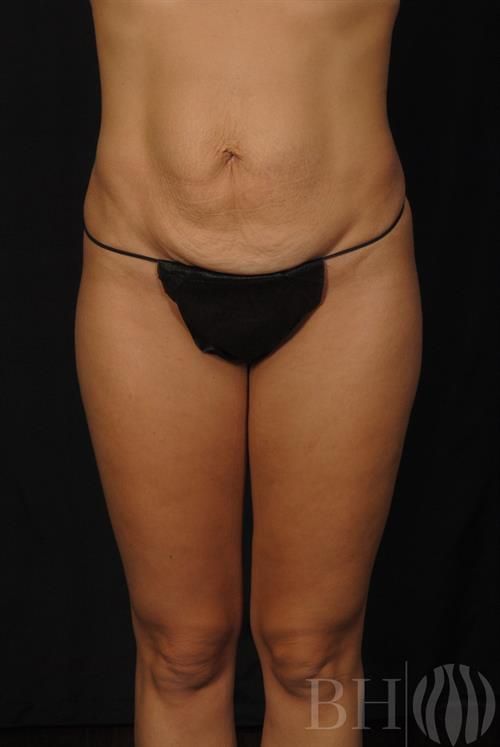 Tummy Tuck Before & After