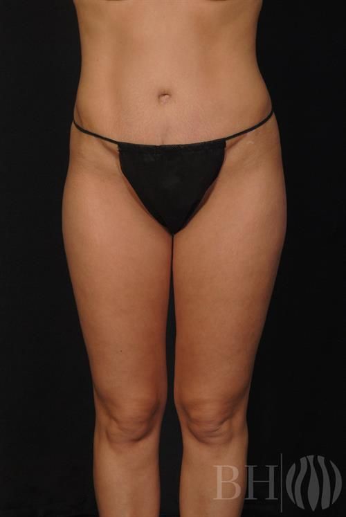Tummy Tuck Before & After