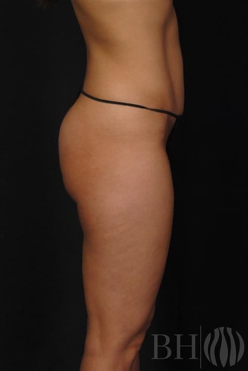 Tummy Tuck Before & After