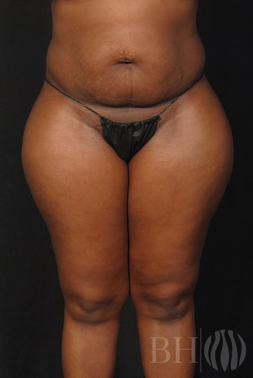 Tummy Tuck Before & After