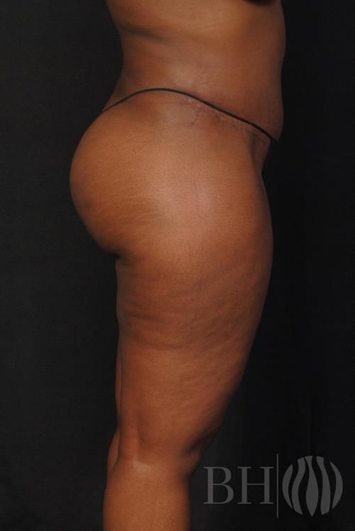 Tummy Tuck Before & After