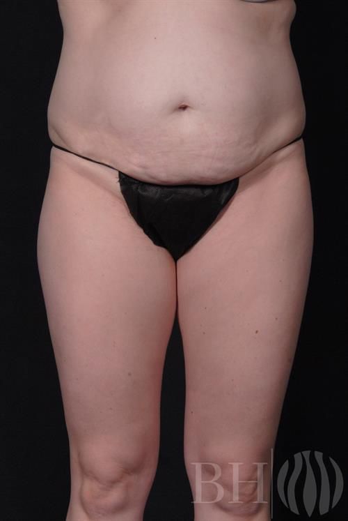 Tummy Tuck Before & After