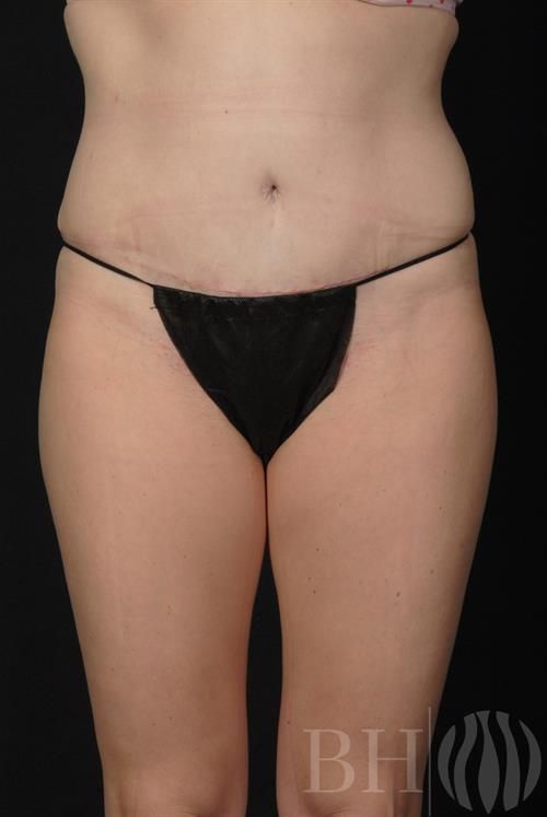 Tummy Tuck Before & After